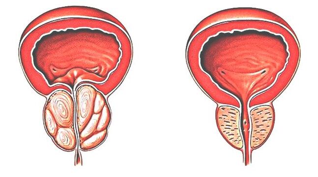 Prostatitisa eta prostata normala