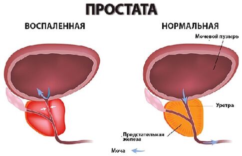 prostatu