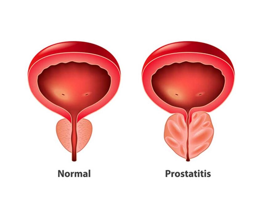 Prostata normala eta hanturazkoa