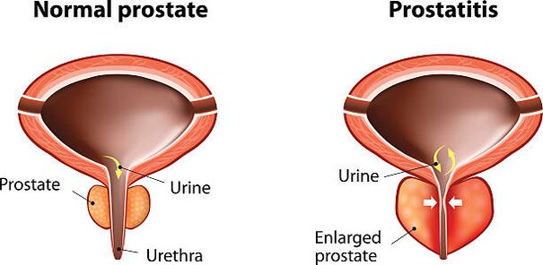 prostata normala eta hantura