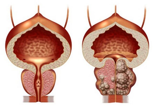 prostatako osasuntsua eta prostatako adenoma